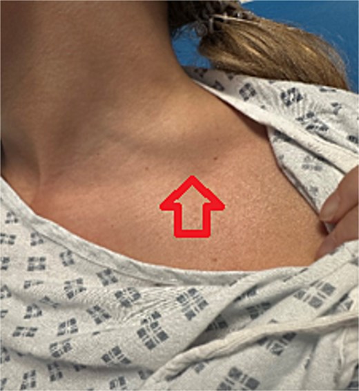 Newly developed supraclavicular lump.