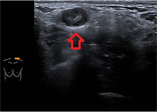 Typical snowstorm appearance of supraclavicular silicone lymphadenopathy.