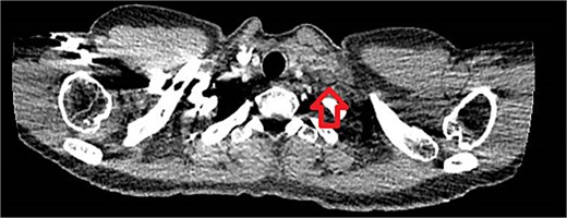 CT thorax showed a 25 × 9 mm supraclavicular mass.