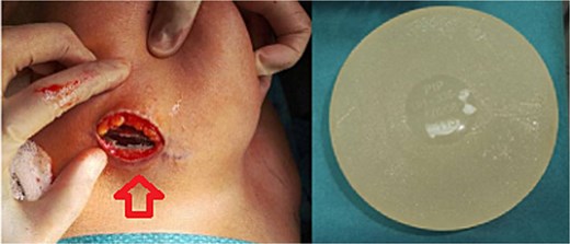 Intact right breast PIP implant.