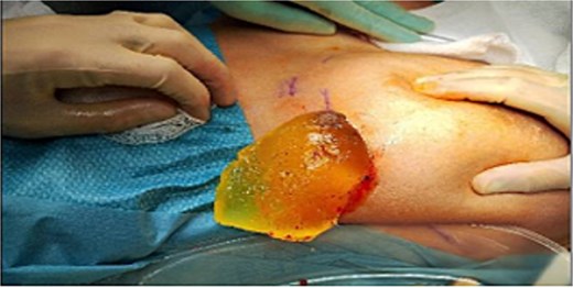 Ruptured left breast PIP implant.