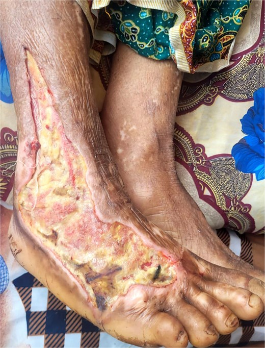 Defect showing extensive tissue damage on the right foot extending to the lower leg.