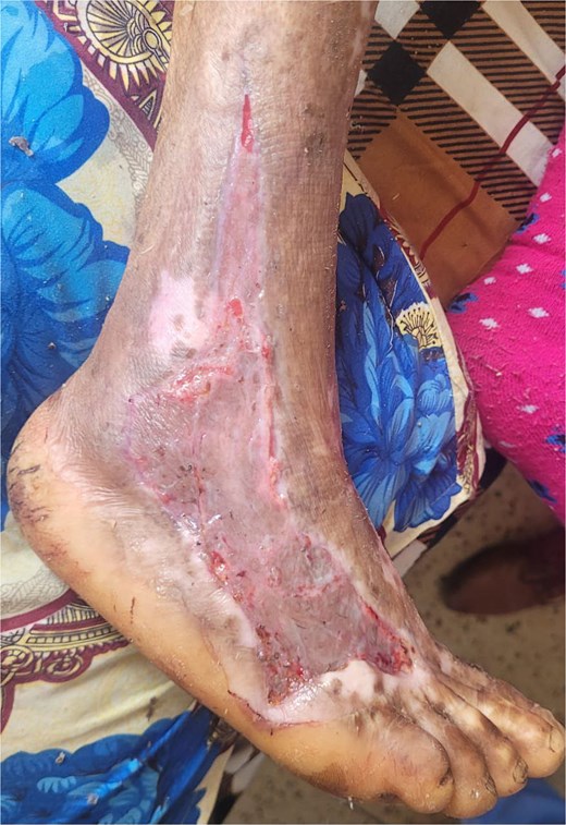 Successful post-operative outcome following split-thickness skin grafting, with complete wound closure and restored skin integrity.