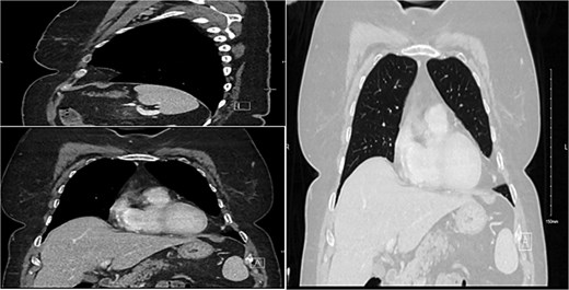 Demonstration of a pleural-based soft tissue mass consistent with lipoma.