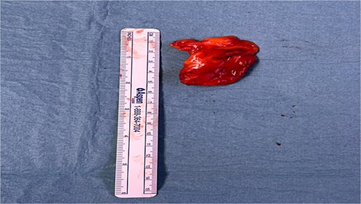Pleural lipoma after surgical resection, sent after for pathological testing.