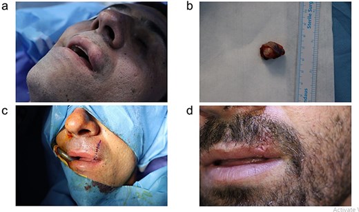 (a) Preoperative appearance of the mass located in the upper lip. (b) The excised mass. (c, d) The postoperative appearance of the patient.