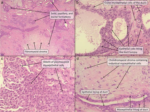 (a) The tumor comprised of solid clusters and ductal structures (some of which showed intraluminal papillary formations) lying within a fibrous and chondromyxoid stroma. (b) The ductal structures were lined by a luminal layer of epithelial cells and an abluminal layer of myoepithelial cells. (c) Some areas showed sheets of plasmacytoid myoepithelial cells with bland nuclei. (d) The chondromyxoid stroma contained individual plasmacytoid myoepithelial cells and ductal structures. Hematoxylin and eosin stain; original magnification 40× (a), 400× (b–d).