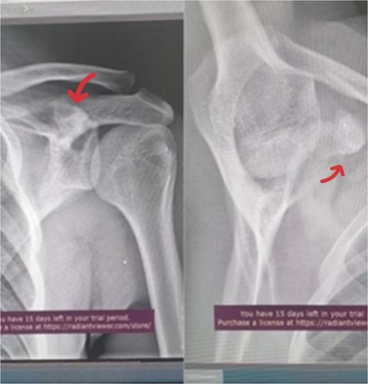 AP radiograph of the left shoulder shows a suspension lesion in the coracoid process of the scapula (indicated by arrow).