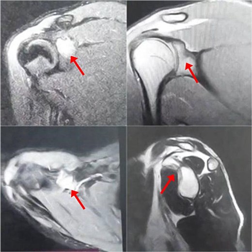 MRI without contrast of the left shoulder show a cortical and subcortical bony defect at the glenoid basecoracoid junction with hyperintense lesion measuring 8 × 7 mm (indicated by arrow), also intense bone marrow edema at the coracoid processes and the glenoid base-coracoid with surrounding fluid and edema extending to the coracoid-humeral space was seen.
