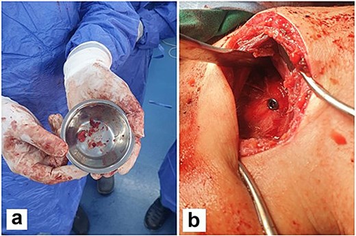 Multiple fragments of tan and bony tissue measuring in aggregate 2 × 1.5 cm taken from the base of the coracoid process (a). Intraoperatively, fixation of the coracoid process with a screw (b).