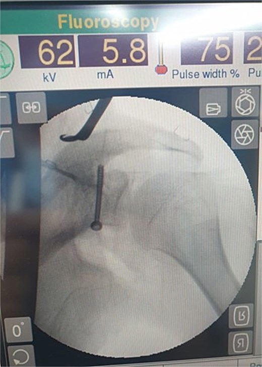 X-ray of the left shoulder post-operatively which shows proper placement of the screw.