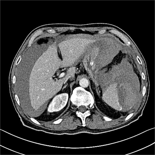 The CT scan reveals splenic hematoma with a significant blood halo surrounding the liver.