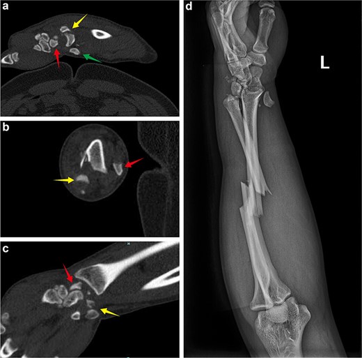 (a) Emergency admission sagittal CT of the wrist showing the dorsal dislocation of the lunate, the fracture end of scaphoid bone in the wrist joint, and the volar displacement of the scaphoid bone. (b) Axial CT of the wrist showing the dorsal displacement of the lunate and the fracture end of the scaphoid bone. (c) Coronal CT of the wrist showing the fracture end of the scaphoid bone and the fracture end of the triquetrum bone. (d) Emergency admission X-ray revealing the dorsal dislocation of the lunate bone, volar displacement of the scaphoid fracture end, injury to the inferior radioulnar joint, and a middle radius-ulnar fracture.