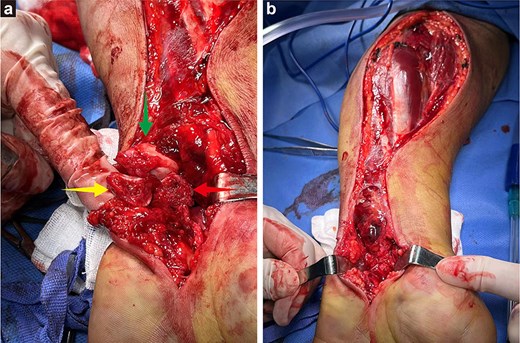 (a) In the first operation, arrows indicate the fracture end of the triquetrum bone, the dislocated lunate (reduced from the dorsal side), and the volar displacement of the scaphoid bone. (b) A lazy S-shaped fasciotomy was performed along the volar aspect of the forearm, indicating total decompression of the volar compartment and wrist during the first surgery.