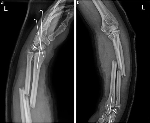 (a and b) After the first operation, X-ray images revealed that the volar displaced scaphoid fracture end had been incorrectly fixed to triquetrum fracture end. Temporary fixation of the unstable wrist joint was achieved using Kirschner wires, while the ulna and radius were not fixed. The lunate bone had not yet been completely repositioned.