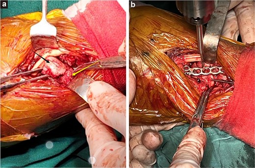 (a) The free scaphoid bone (black arrow) was mistakenly repositioned with the triquetrum bone (yellow arrow). (b) The wrist bones were stabilized with a small plate during surgery, maintaining the stability of the radiocarpal joint.