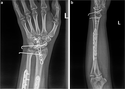(a and b) Anterior and lateral views of the wrist joint following the second postoperative intervention, demonstrated satisfactory reduction of the fracture ends of the wrist bones, and the lunate bone had been relocated.