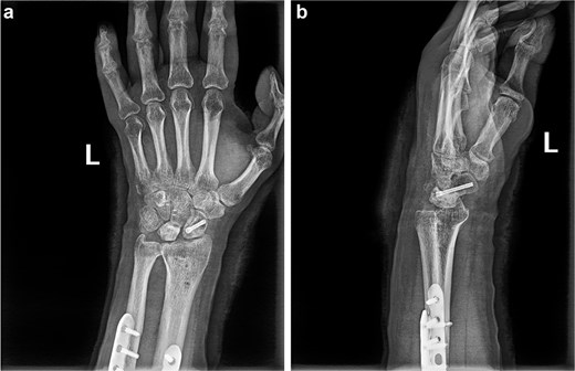 (a and b) Anterior and lateral views of the wrist joint after 6-month follow-up.