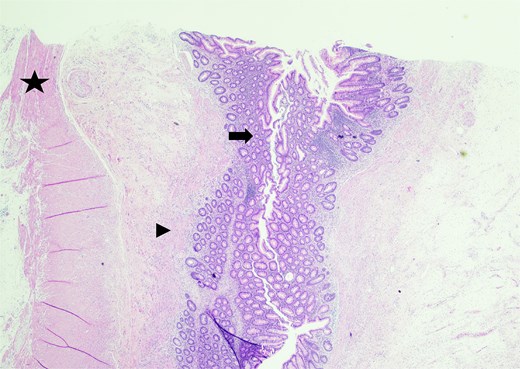 Sectioning of the intact vermiform appendix, top portion, showing the muscularis propria (star), muscularis mucosa (arrowhead), and colonic mucosa (arrow).