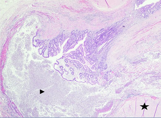 Sectioning of the intact vermiform appendix, bottom portion, with the appendiceal diverticula showing the muscularis propria (star) and acute inflammatory cells, neutrophils (arrowhead), within.