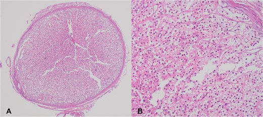 (A) Adrenal cortical ectopic tissue was found incidentally as a well-demarcated nodule during herniorrhaphy in a 35-year-old woman. (B) Microscopic view of the same nodule showing clear to eosinophilic epithelial cells arranged in cords and nests.