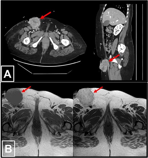 Radiological imaging of the right inguinal mass. (a) Contrast-enhanced CT scans of the abdomen and pelvis in axial (left) and sagittal (right) views, demonstrating a pathologically enlarged necrotic right inguinal lymph node (red arrow), measuring 5.3 × 6.2 × 8.5 cm. The mass is ulcerating into the inguinal skin and is in very close proximity to the adjacent inguinal vessels. (b) MRI of the pelvis in T1-weighted (left) and T2-weighted (right) sequences, again revealing the pathologically enlarged necrotic right inguinal lymph node (red arrow).