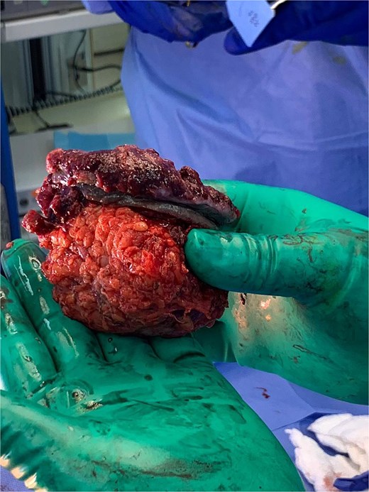 Gross image of the partially resected right inguinal mass showing nodularity and ulceration.