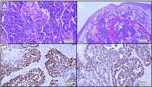 Histopathological and immunohistochemical analysis of the partially resected inguinal mass. (a) Higher magnification of hematoxylin and eosin (×100) revealed pleomorphic neoplastic cells with a high nuclear-to-cytoplasmic ratio, prominent nucleoli, and frequent mitoses. (b) Hematoxylin and eosin (×20) stained slides showed infiltrative carcinoma with glandular, cribriform, and solid growth patterns, overlaid by skin. Immunohistochemical analysis (×100) revealed that the tumor cells stained positive for (c) TP53 and (d) PAX8.