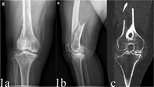 Preoperative anteroposterior radiographs of the case, sustained a displaced spiral fracture of the distal femur (AO/OTA type A1.2) and knee OA (Kellgren-Lawrence grade IV) (a and b). CT scans knee OA (Kellgren-Lawrence grade IV) (c).