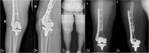 Post-operative fracture fixation with TKA and locking plate (a and b). Four years later, healed for review only fracture with implants in situ (c–e).