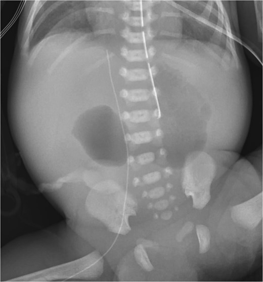“Double bubble” sign on X-ray.
