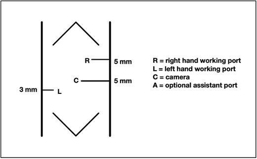 Standard laparoscopic duodenostomy port placement.