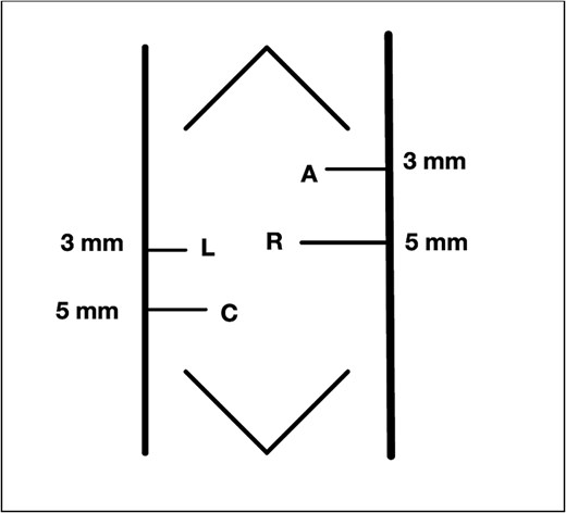 Our modified port placement.