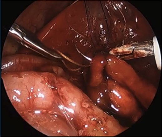 Laparoscopic view of anastomosis. The surgery was completed successfully laparoscopically, and the patient had no postoperative complications.