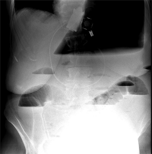 X-ray massive gastric dilatation and small bowel dilatation with air-fluid levels.