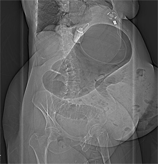 Massive gastric and small bowel dilatation.