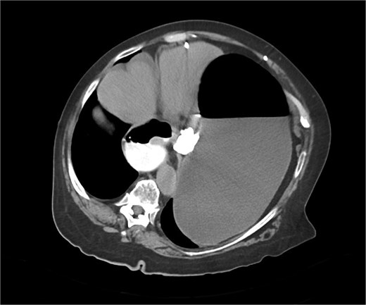 CT axial view—contrast media in distal esophagus did not pass to the stomach.