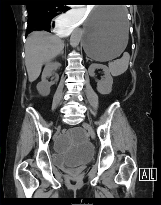CT coronal view—NGT stuck in distal esophagus.