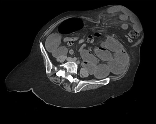 CT axial view—obstructed ventral hernia with proximal small bowel loop dilatation.