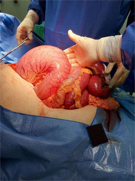 Massive gastric dilatation filled with air and fluid.