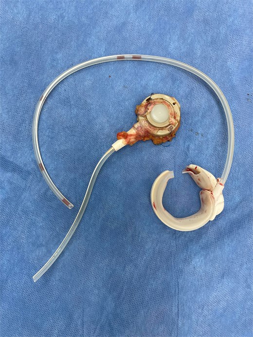 Removed band.