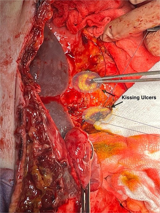 Anterior and posterior duodenal ulcers (arrows), each surrounded by yellow rim.