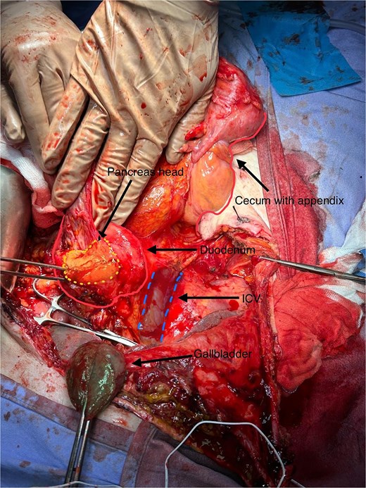 Total mobilisation of ascending colon and caecum (Cattel-Braasch manoeuvre) and complete Kocher manoeuvre, with inferior vena cava (IVC) and aorta exposed, leaving gallbladder in place for liver traction.