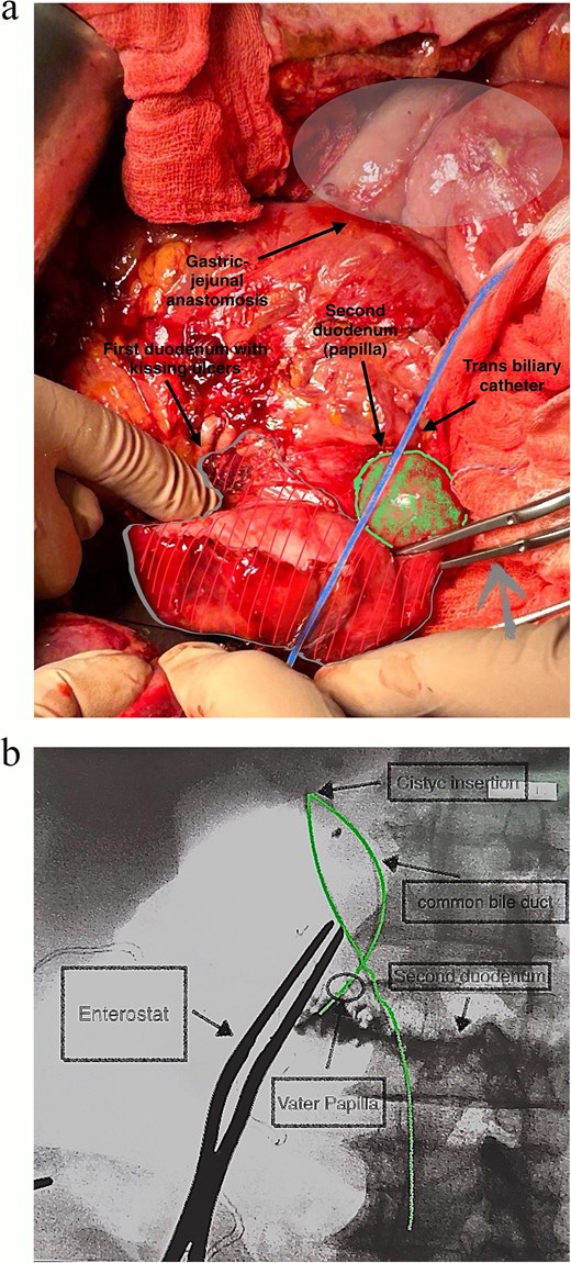 (a and b) Catheter placed within cystic duct to radiographically localise papilla of Vater during surgery, having positioned enterostat (grey arrow) immediately distal to posterior ulcer.