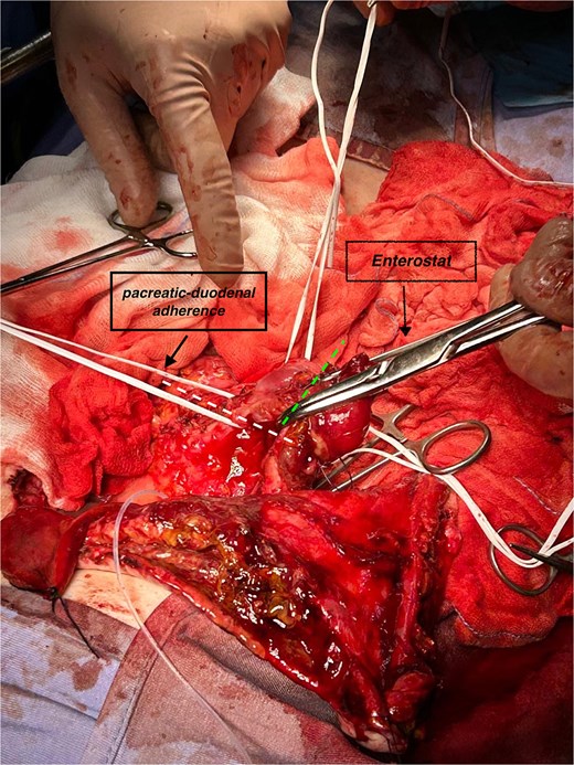Focal pancreatic/duodenal adherence (loop in the left indicates section line) and duodenum proximal to papilla (other loop, sectioned at dashed line) before enterostat positioning.