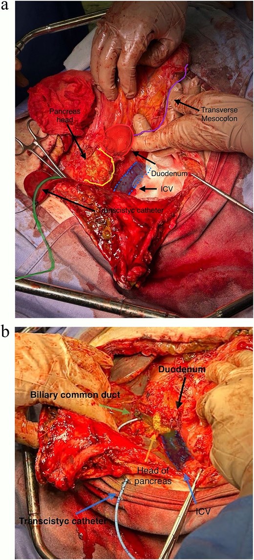 (a and b) Completed pancreas-sparing duodenectomy, exposing head of pancreas, IVC and common bile duct (transcystic catheter retained).