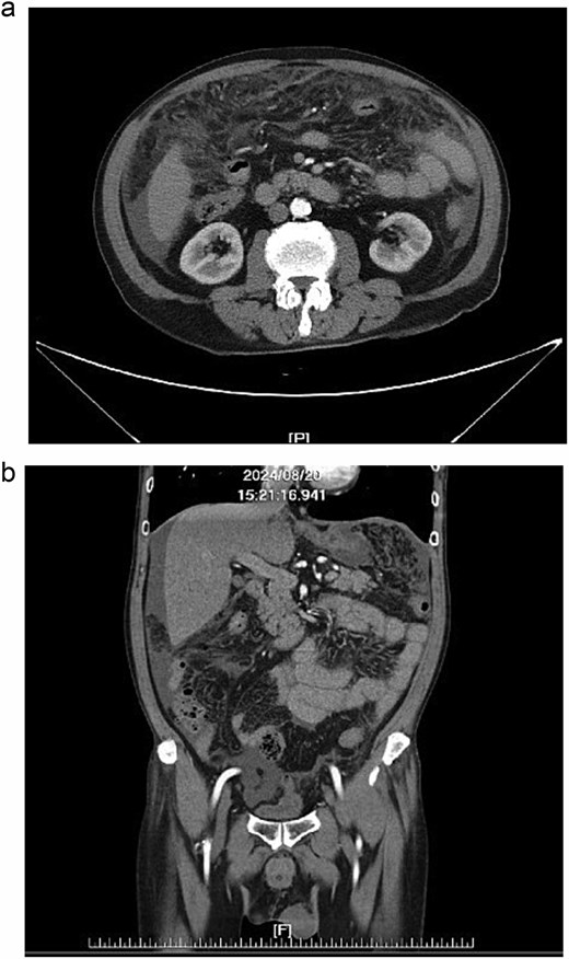 (a, b) Abdominal CT, peritoneal thickening with multiple miliary nodules and omental cake with ascites.