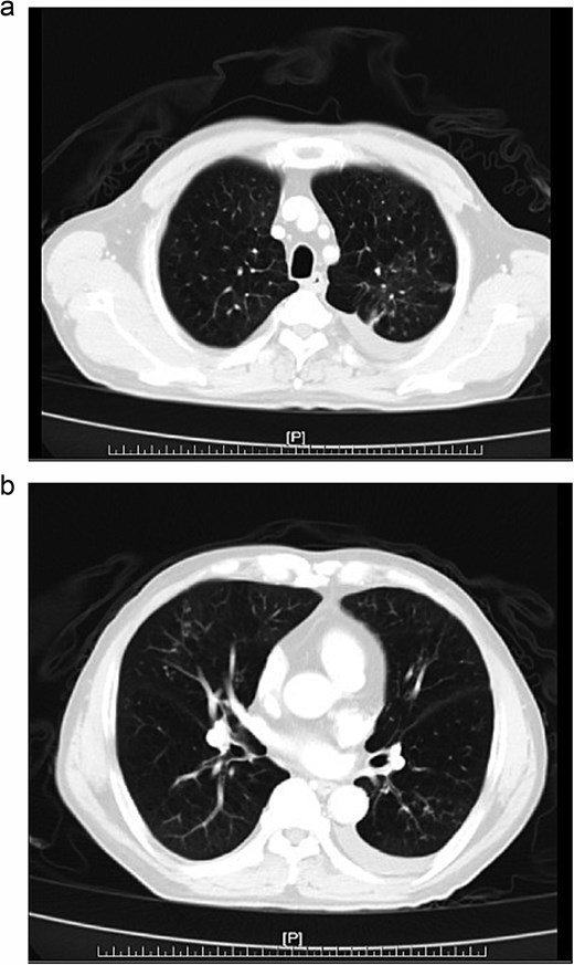 (a, b) Chest CT, multifocal of patches of centrilobular nodules and tree-in-bud in bilateral lungs.