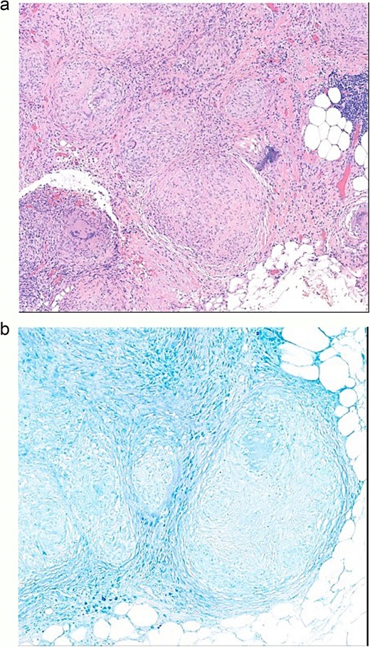 (a) Omentum pathology, non-necrotizing granulomatous inflammation. (b) Omentum pathology diagnosis, acid-fast stain negative.