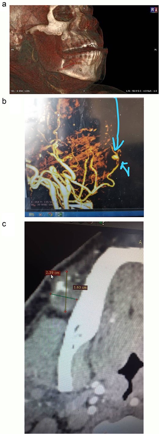 CT images illustrating the right facial artery aneurysm: (a) 3D-reconstructed CT scan highlighting the aneurysm. (b) Preoperative contrast-enhanced CT with 3D reconstruction indicating the aneurysm. (c) Preoperative axial contrast-enhanced CT demonstrating the saccular aneurysm of the right facial artery and its measurements.